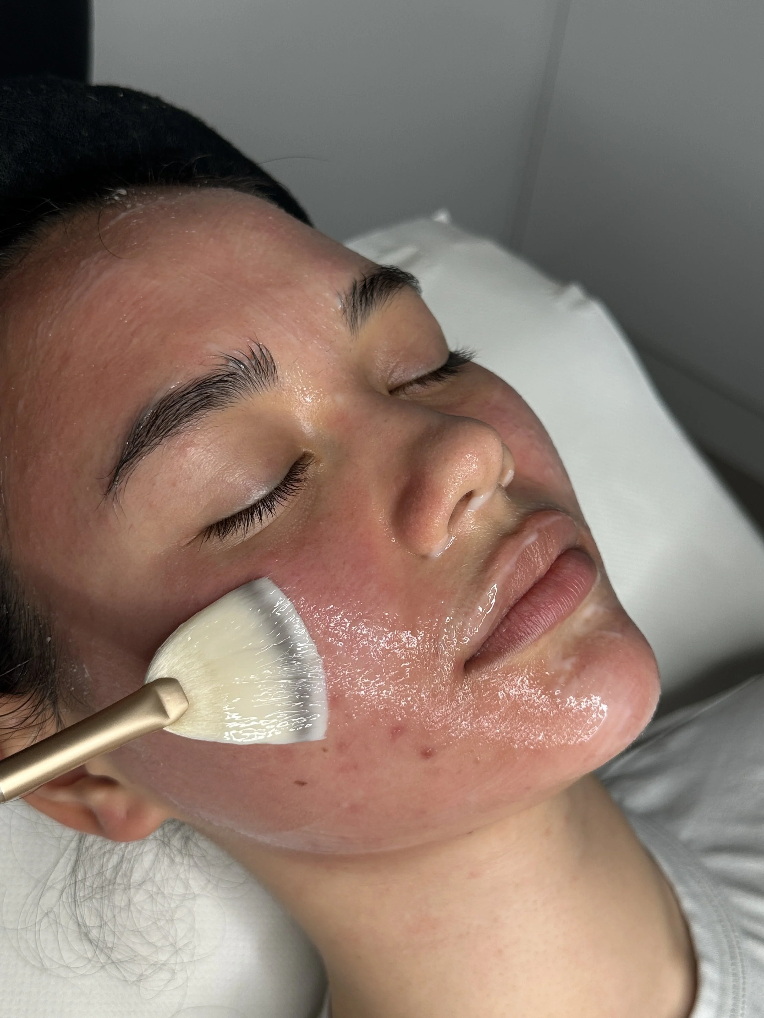 The Ultimate Guide To Chemical Peels