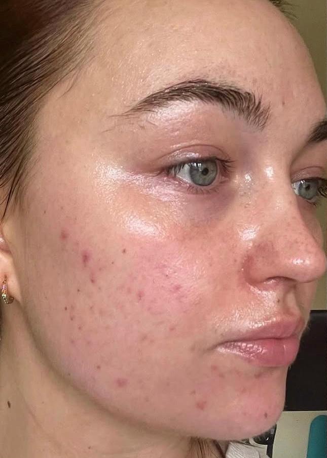 Treatment area before procedure